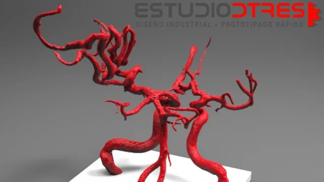 Impresiones 3D en cirugías complejas